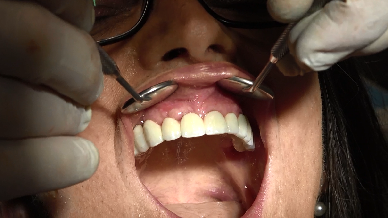 Implantologia senza osso a carico immediato possibile solo con Bilateral sinus solution ALLONFULL BSS