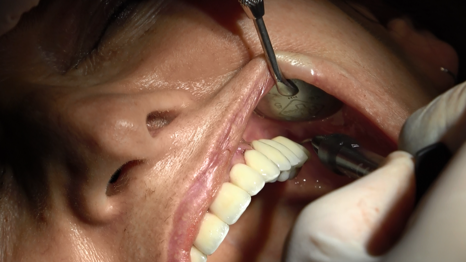 Denti fissi senza osso Milano